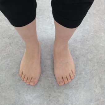 外反母趾の痛み（足指の痛み）とインソール処方の一例