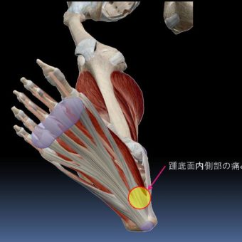 踵部底面内側の痛みに対するインソール処方